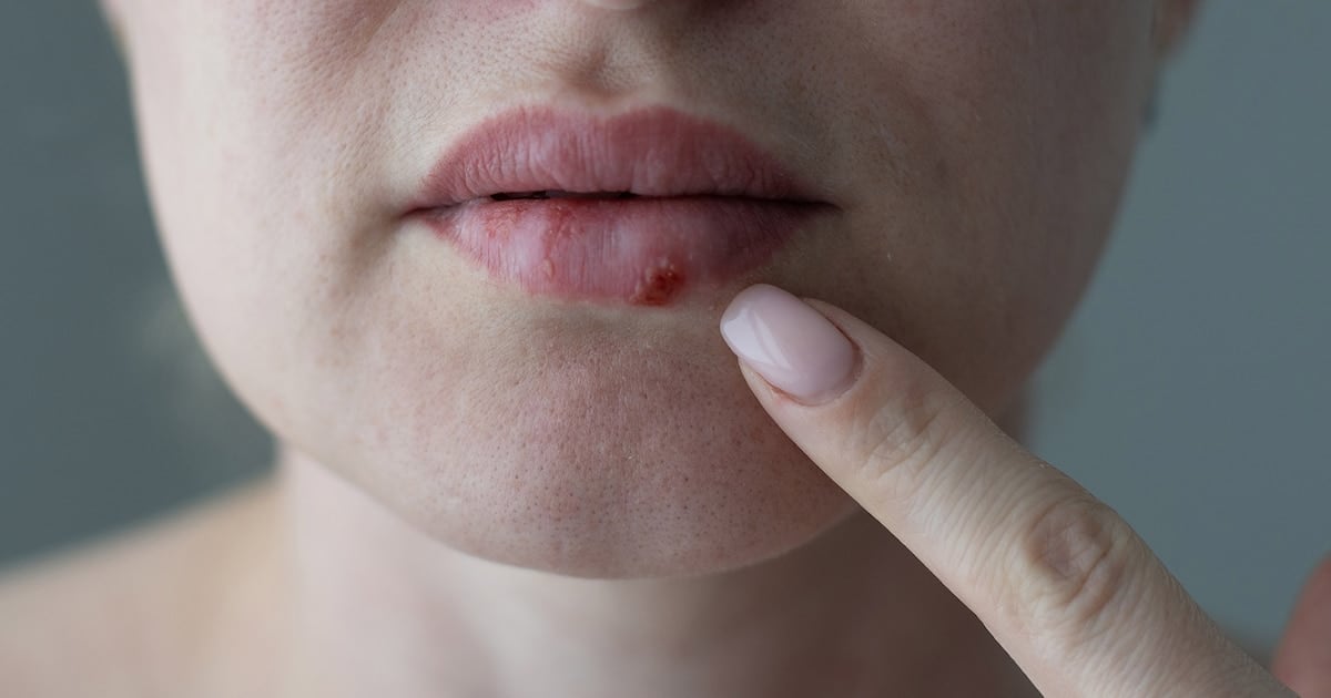 Un antiviral oral inédito para el herpes que no responde a los tratamientos disponibles llega a pacientes inmunocomprometidos