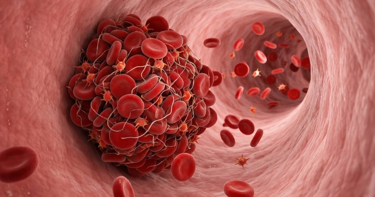 Cuando la sangre se detiene: las cuatro pistas que el cuerpo avisa antes de una trombosis