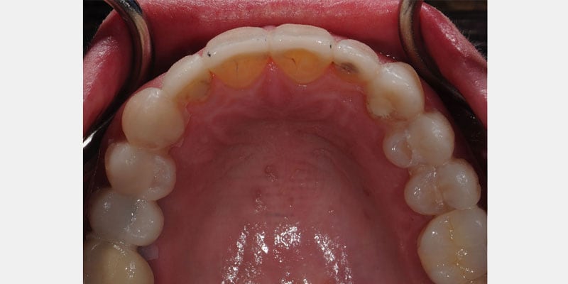 Filtraciones en carillas dentales: las señales que exigen atención